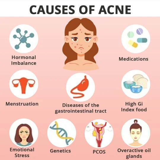 Acne Causes